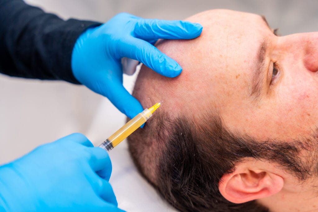 Dermatologist injecting centrifuged blood into man's head to treat baldness